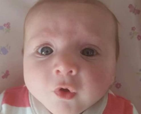 Cleft Palate